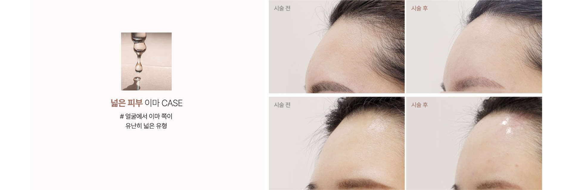 넓은 피부 이마