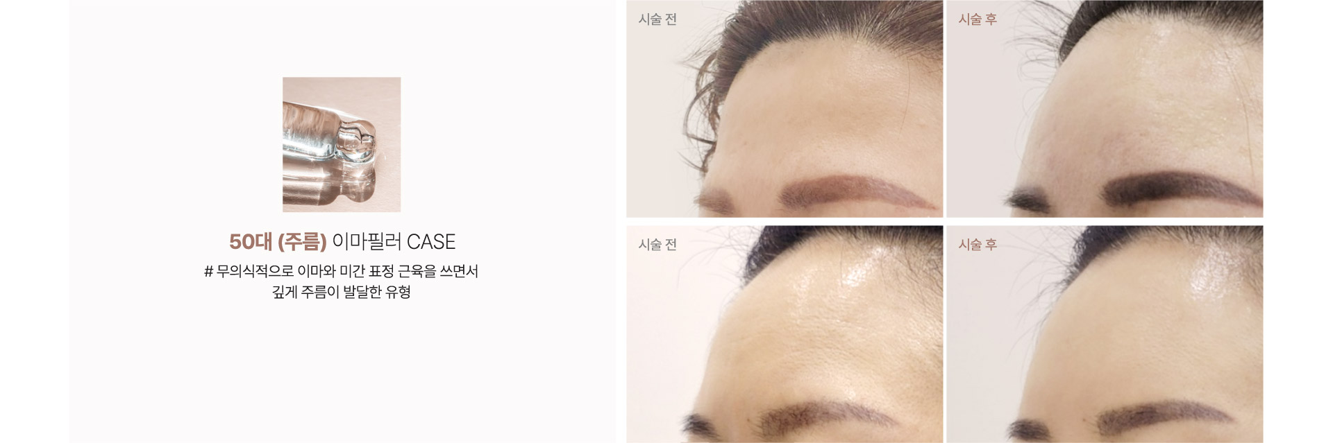 50대(주름) 이마