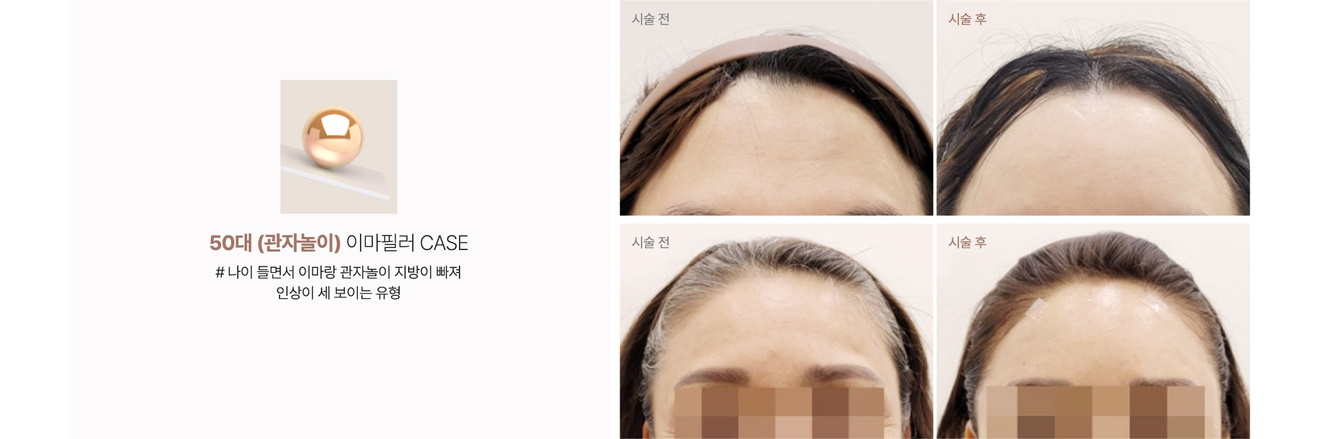 50대(관자놀이) 이마