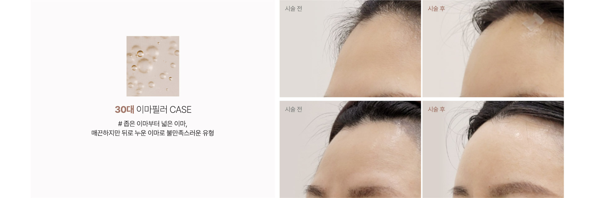 30대 이마